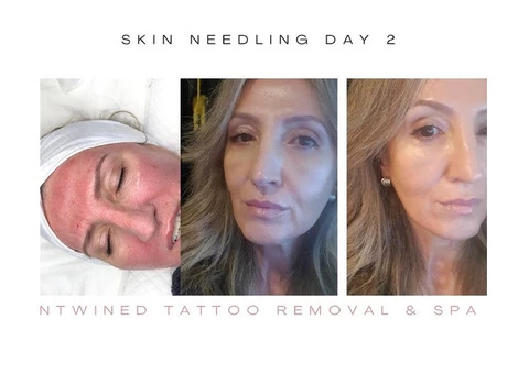 Tattoo Removal & Spa Adelaide - 2/2