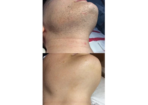 Time to Shine: Hair Removal For Men Near You