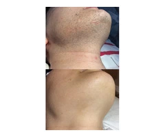 Time to Shine: Hair Removal For Men Near You