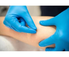 Dry Needling Adelaide