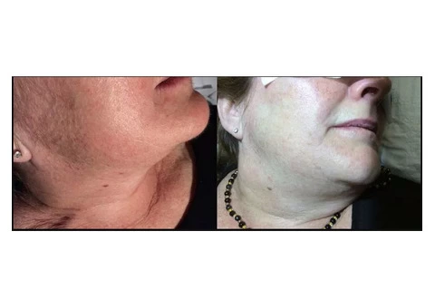 Glowing Skin With Facial Hair Removal