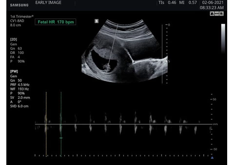 A Key to a Happy & Stress-Free Pregnancy - Stress Relief Scan