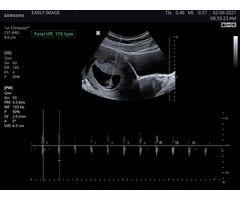 A Key to a Happy & Stress-Free Pregnancy - Stress Relief Scan