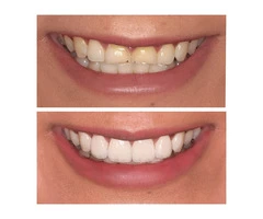 Porcelain Veneers Crafts Mesmerizing Smiles with Perfect Veneers