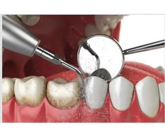 Teeth Cleaning Penrith