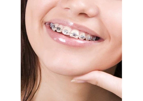 Your Trusted Smile with Best Braces at Clear Braces Orthodontics in Sydney! - 1/4