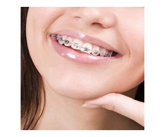 Your Trusted Smile with Best Braces at Clear Braces Orthodontics in Sydney!