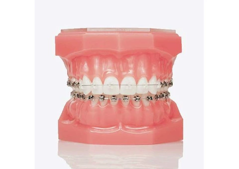 Your Trusted Smile with Best Braces at Clear Braces Orthodontics in Sydney! - 2/4