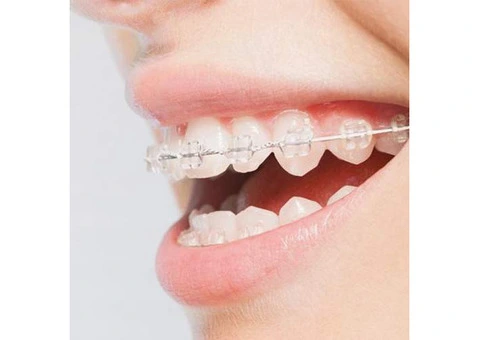 Your Trusted Smile with Best Braces at Clear Braces Orthodontics in Sydney! - 3/4