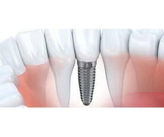 Dental Implant Centre
