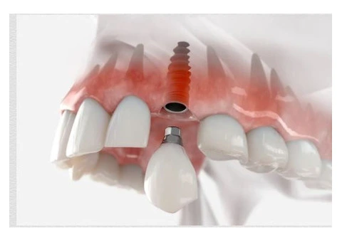 Dental Implants Penrith