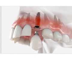 Dental Implants Penrith