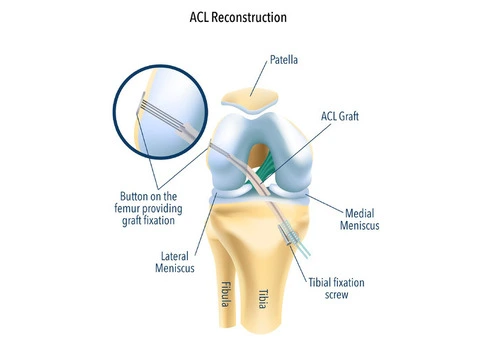 Tackle Your Knee Pain Head-On with Hamstring ACL Reconstruction