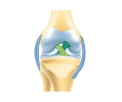 Staying Strong and Stable With Knee Ligament Surgery