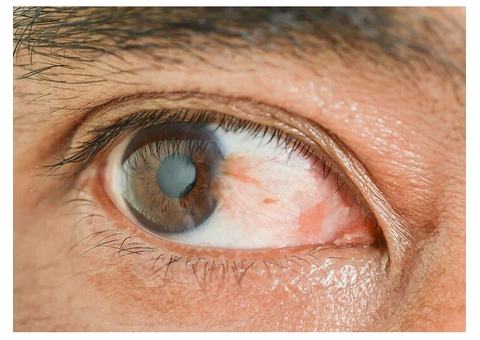 Say Goodbye to Pterygium with Dr Joanne Goh's Treatment