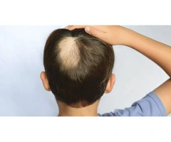 Top Tips in Coping up With Children's Alopecia from Hair Treatment Perth