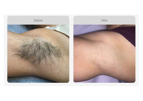 Should You Opt for At-Home or Salon-Based IPL Hair Removal Treatment?