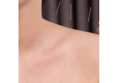 Discovering the Healing Art of Acupuncture Treatment in Melbourne