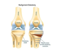 Move Pain-free with Osteotomy Surgery
