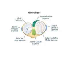 Fix Your Knee with Expert Meniscus Tear Surgery