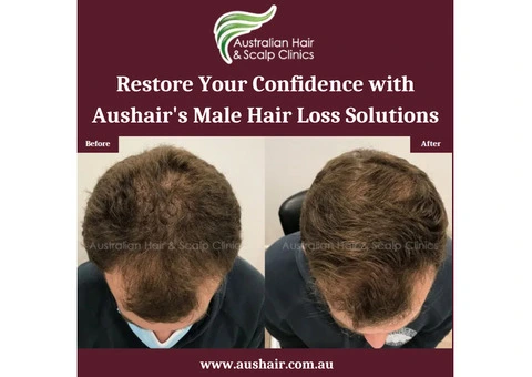 Restore Your Confidence with Aushair's Male Hair Loss Solutions
