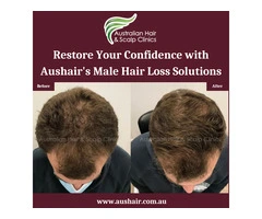 Restore Your Confidence with Aushair's Male Hair Loss Solutions
