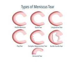 Protect Your Knee with Advanced Meniscus Tear Treatment