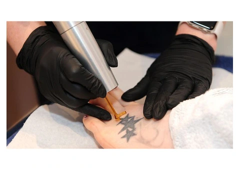 Advanced Laser Hair and Tattoo Removal in Perth - 2/2