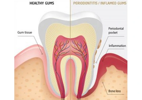 Discover the Power of Deep Cleaning with Grandis Dental in Banksia Grove