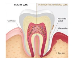 Discover the Power of Deep Cleaning with Grandis Dental in Banksia Grove