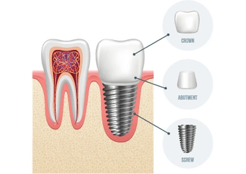 Smile Fresh: The Magic of Dental Implants