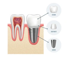 Smile Fresh: The Magic of Dental Implants
