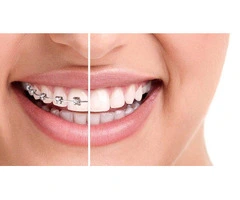 Get Invisalign Braces Treatment at Affordable Prices in Sydney