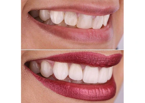 Bring a Transition into Your Life with Porcelain Veneers in Sydney