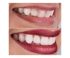 Bring a Transition into Your Life with Porcelain Veneers in Sydney