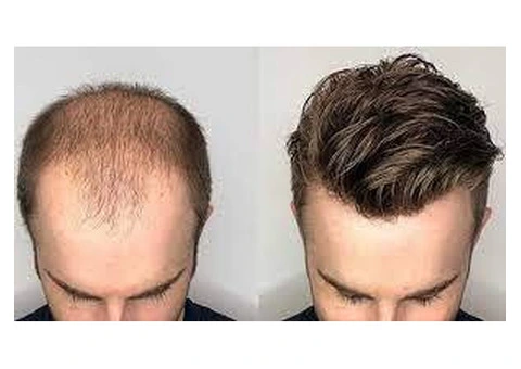 Budget-Friendly Solutions: Exploring Cheap Men's Hairpieces for Every Need