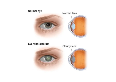 Clear Vision Ahead: All About Cataract Surgery