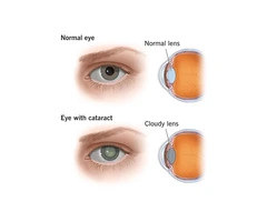 Clear Vision Ahead: All About Cataract Surgery