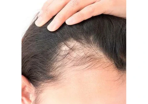 Checkout the Best Women's Hair Fall Treatment Perth