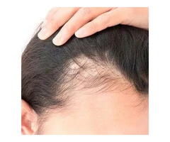 Checkout the Best Women's Hair Fall Treatment Perth