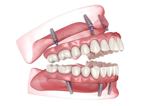 Smile Renewed: All-On-4 Dental Solution