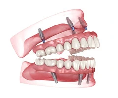 Smile Renewed: All-On-4 Dental Solution