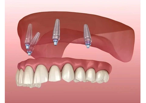 Get a Dental Implant Treatment with Comfort and Safety in Banksia Grove