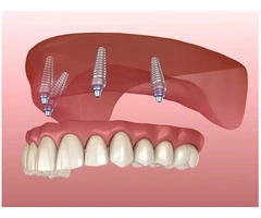 Get a Dental Implant Treatment with Comfort and Safety in Banksia Grove