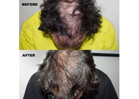 Book a Doctor on the Experts of Hair Loss Treatment Western Australia!