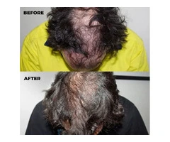 Book a Doctor on the Experts of Hair Loss Treatment Western Australia!