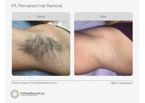 SHR Hair Removal Services Carnegie | Waxing Queen Salon