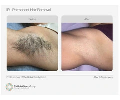 SHR Hair Removal Services Carnegie | Waxing Queen Salon