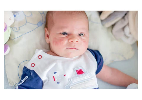 Learn About Childhood Rashes with Early Childhood Education Byford