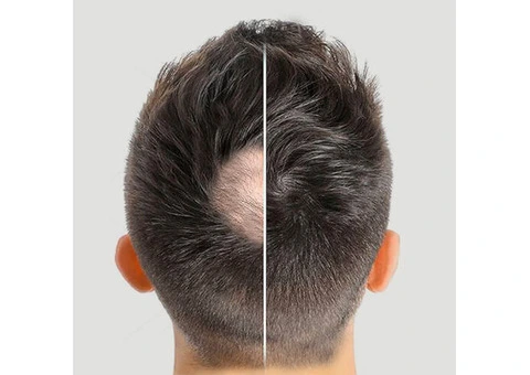 Checkout the Seamless Integrated Hair System from Hair Fall Treatment Experts Perth